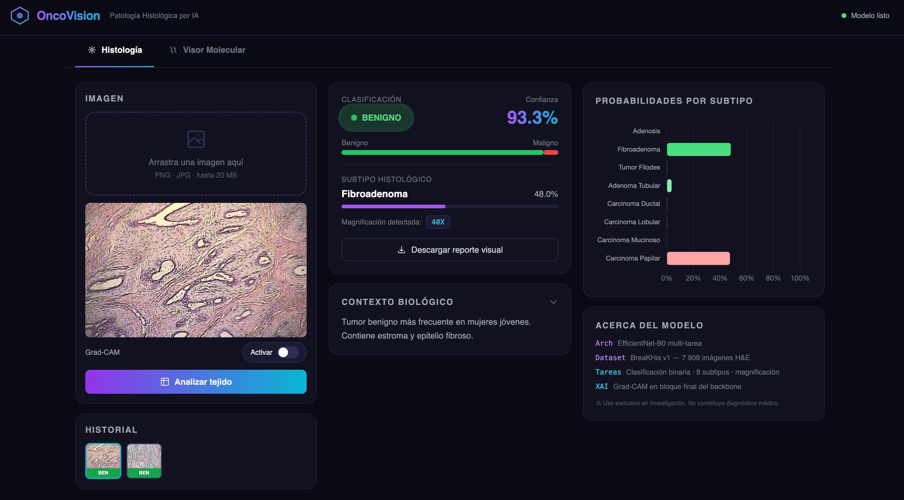 OncoVision interface showing a histology slide beside its Grad-CAM heatmap